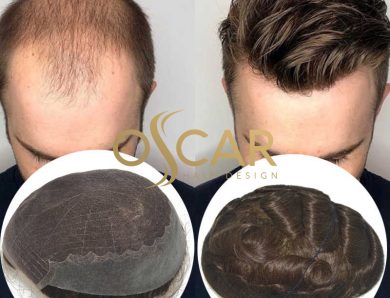 Yeni Nesil Protez Saç Tedavisini Oscar Hair Protez Saç Merkeziyle Görün
